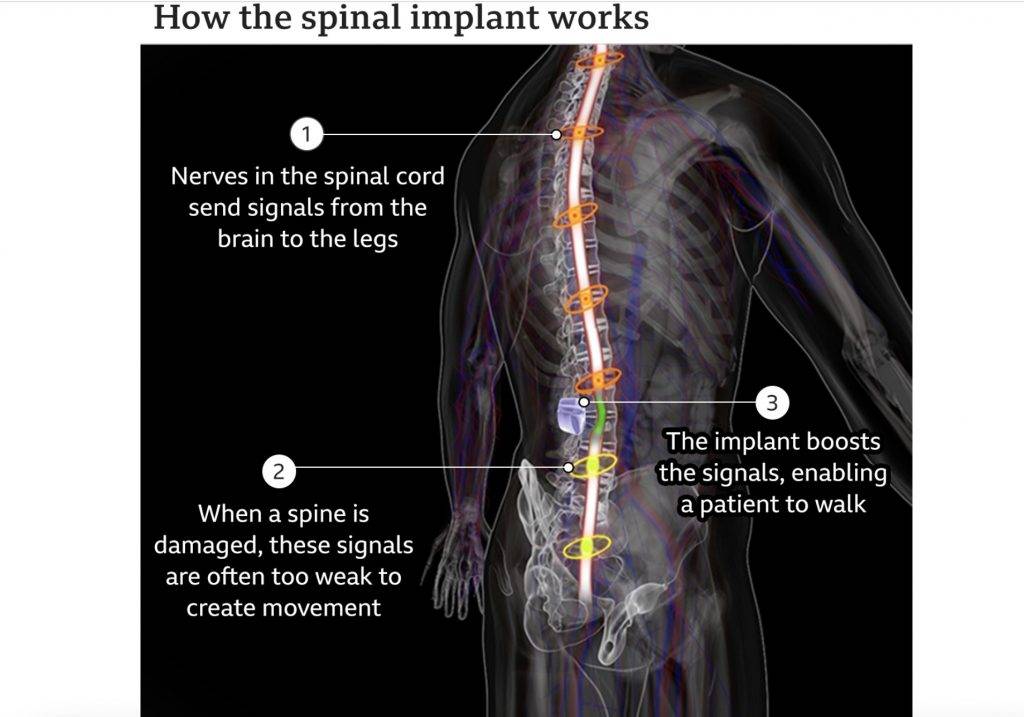 0208spinalimplant 4 - Gli impianti consentono ai pazienti paralizzati con midollo spinale reciso di camminare di nuovo, un “miracolo” medico?