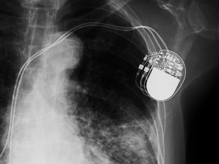 0530dissolvingpacemaker-1-1024x768.jpg!720